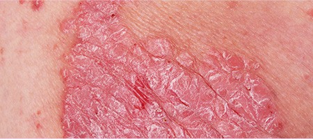 Types of Psoriasis - Pustular Psoriasis